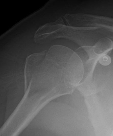 Shoulder Dislocation Non Displaced GT Fracture